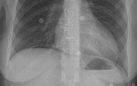 38-year-old with progressive abdominal pain