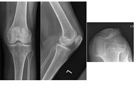 53-year-old woman with limited motion and pain in knee
