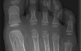 3-year-old female with foot pain after fall