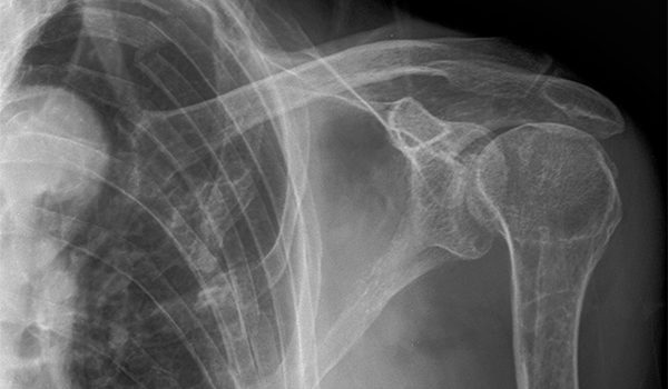 80-year-old male who suffered a blow to the left side of his chest