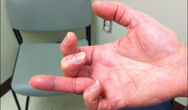 55-year-old woman with injury to her right finger