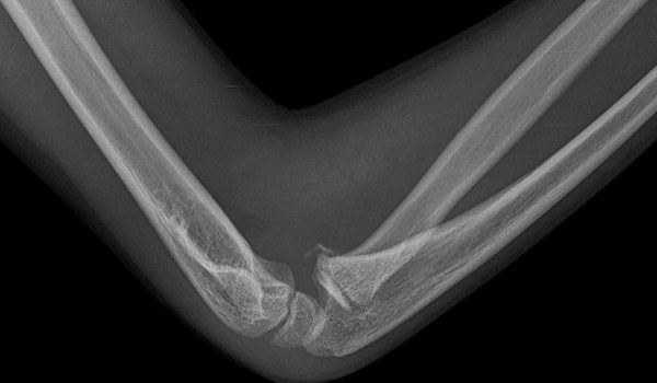 8-year-old girl with a blow to her right elbow
