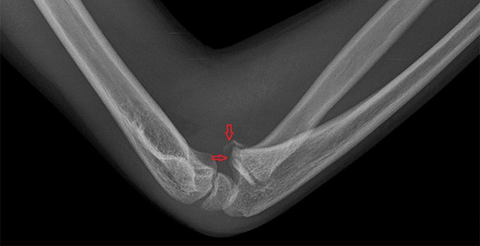 Elbow X-Ray of an 8 year old girl that took a blow to her arm