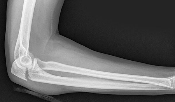 60-year-old woman with swelling in her right arm after a fall