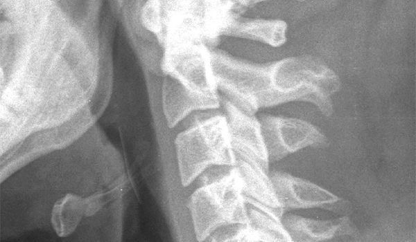 30-year-old male with a complaint of feeling something stuck in his throat