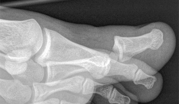 18-year-old male with a blow to his right foot