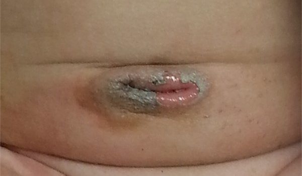 5-week-old male with skin peeling around the "belly button"