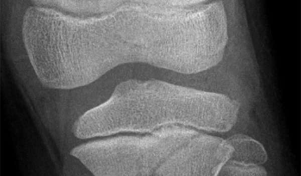 6-year-old male with a blow to his left knee