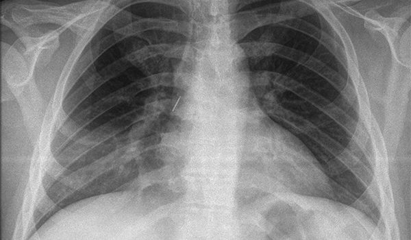 25-year-old female with autism and a 1-week history of fever