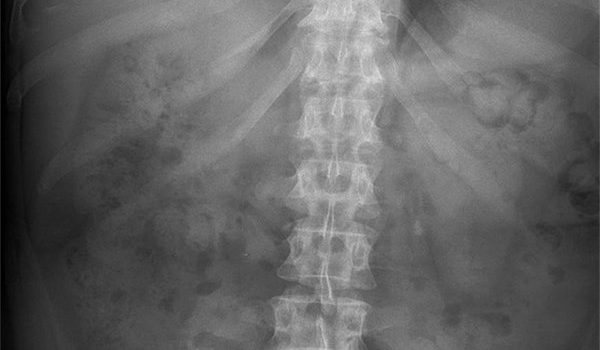 53-year-old woman with nonspecific complaints of significant abdominal pain