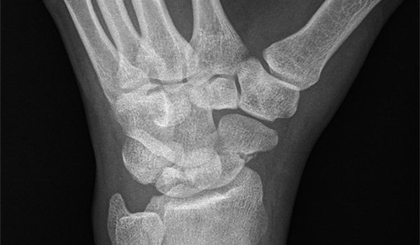 23-year-old male presented after blow to left wrist