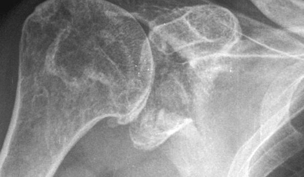 76-year-old male presented after blow to right shoulder