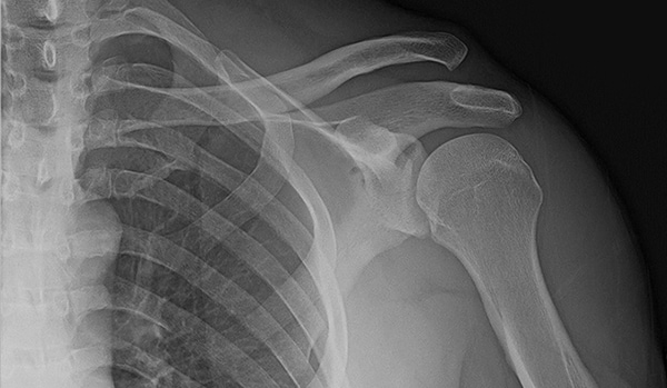 28-year-old male with pain in shoulder after fall