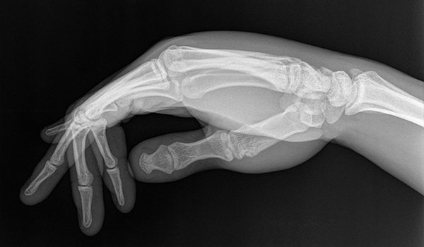 X-ray of man with a crush injury to hand