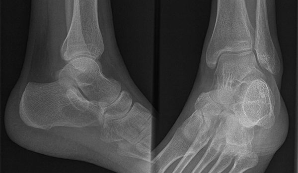 23-year-old male complains of heel pain since slipping down steps