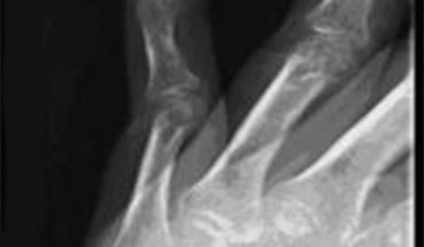 35-year-old female catches finger in banister