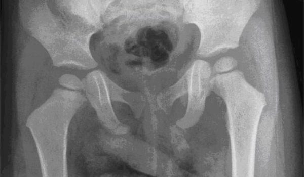 2-year-old boy with sudden pain in left leg