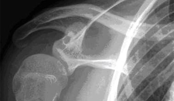 19-year-old male experiencing pain in shoulder