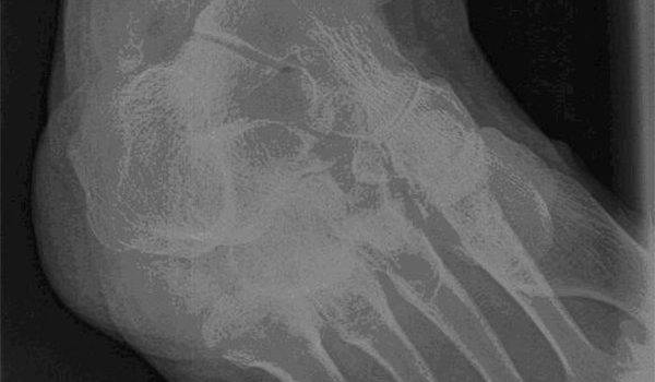 93-year-old female with a twisted ankle