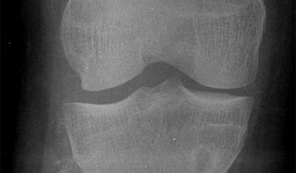 20-year-old female with knee pain after fall