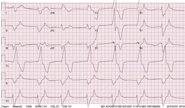 37-year-old diabetic female feeling weak after switching diuretics