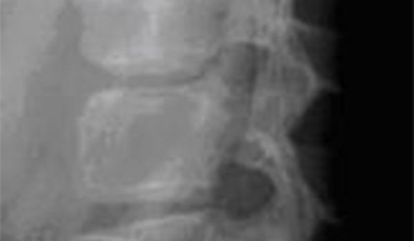 14-year-old boy with lower back pain stemming from fall