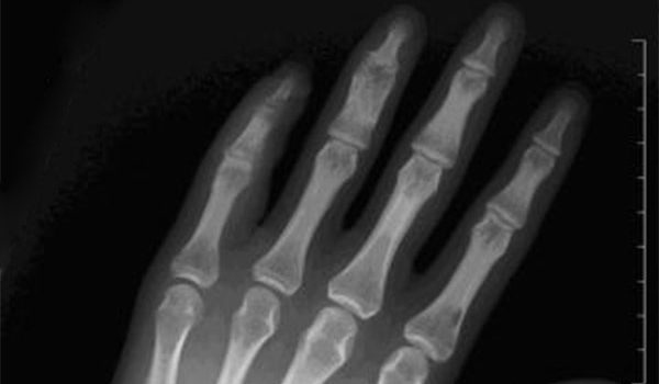 23-year-old male has persistent wound after crushing finger