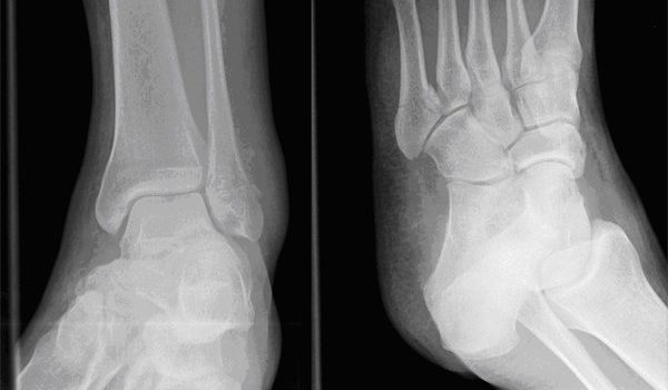 42-year-old woman in considerable ankle pain