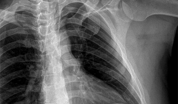 32-year-old patient sustains blow to chest