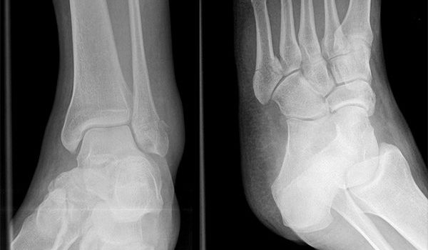 42-year-old man unable to bear weight on his ankle