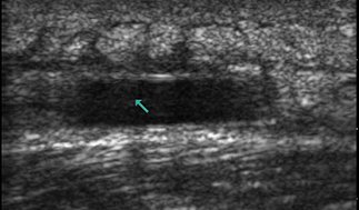 The Role of Ultrasound for Soft Tissue Infections in the Urgent Care Setting