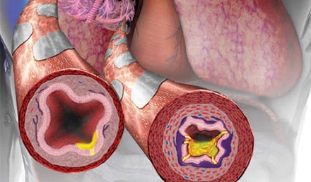 Assessment and Management of Asthma Exacerbation in Urgent Care: Part 1