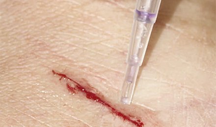 Quick-Sealing Surgical Glue Closes Wounds in Seconds 