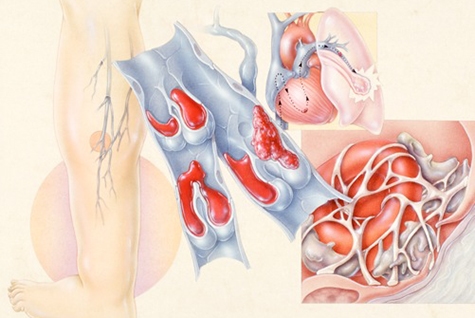 Outpatient Management of Deep Venous Thrombosis