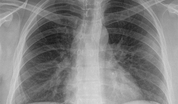 21-year-old patient with chest pain on the left side