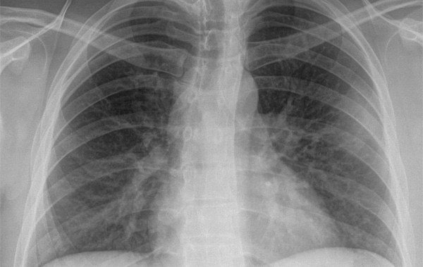 21-year-old patient with chest pain on the left side | Journal of