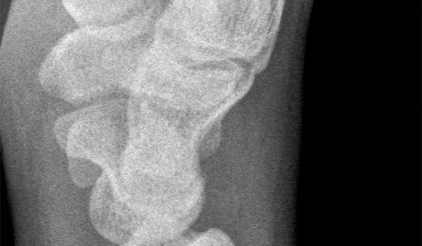 16-year-old patient presents with blow to the left wrist