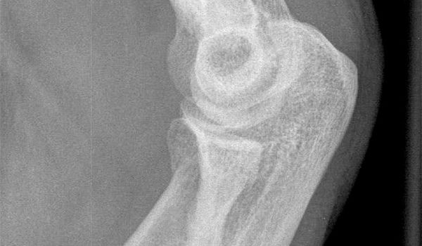 49-year-old patient exhibits pain after blow to elbow