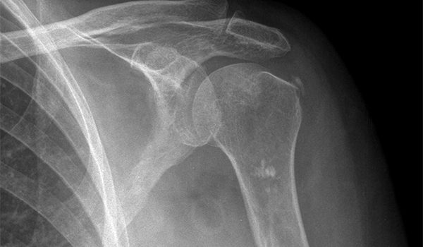 70-year-old experiencing shoulder pain