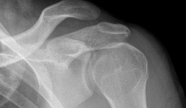 26-year-old presents limited range of motion in shoulder