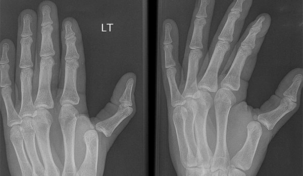 32-year old experiences deforming blow to left thumb