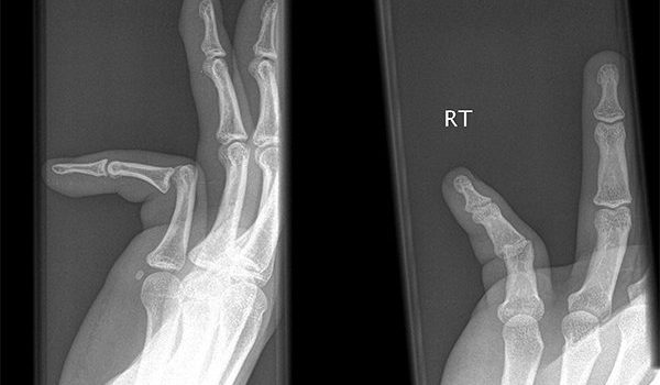 27-year-old presents a jammed right finger