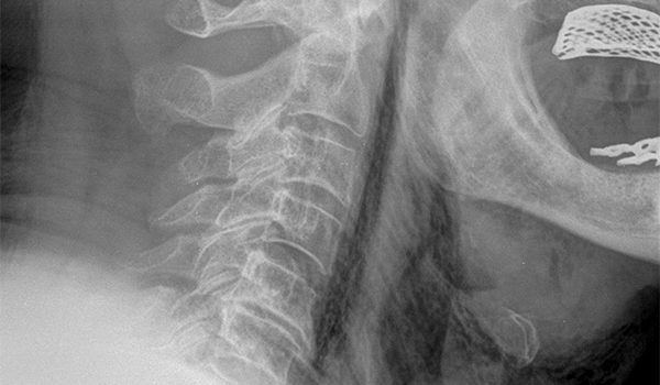 75-year-old experiencing dysphagia after swallowing bone