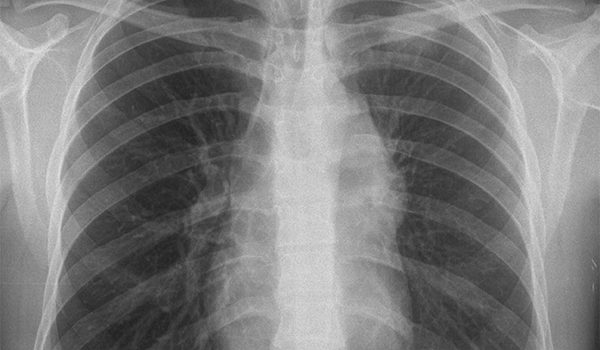 21-year-old presents with hemoptysis