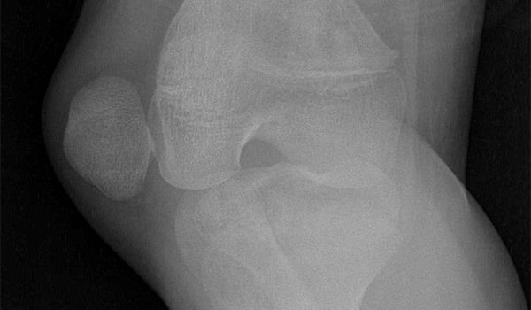 9-year-old patient trips and receives a blow to right knee