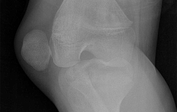 9-year-old patient trips and receives a blow to right knee - Journal of ...