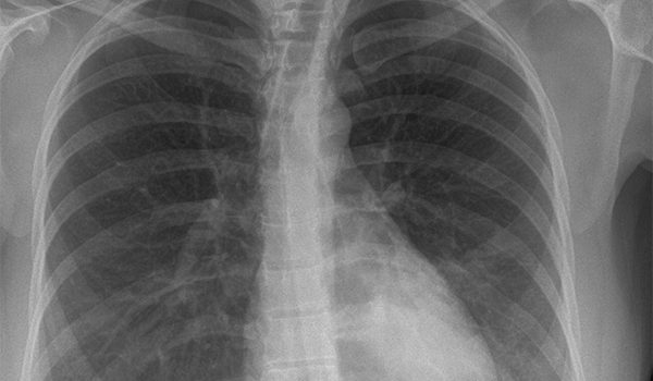 32-year-old female presents with cough and fever