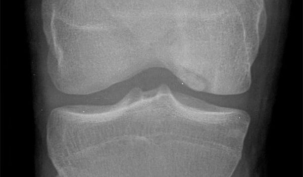 20-year-old has an incidental finding on his x-ray