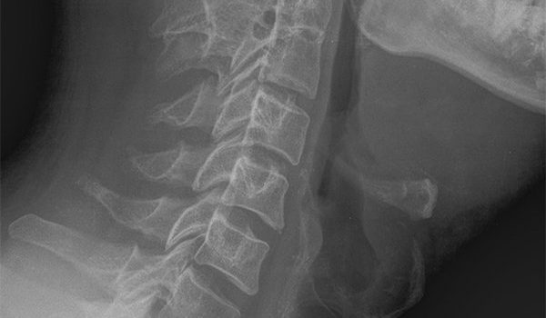 40-year-old female presents with dysphagia