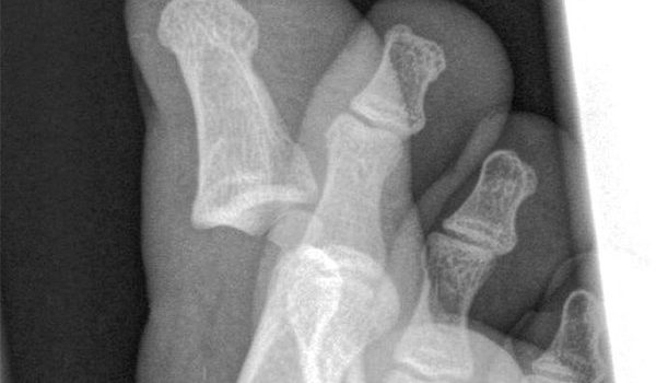 9-year-old female suffering after a blow to her right hand